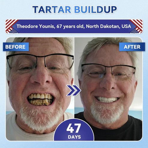 Your Smile~ 🦷 Tideglusib Fast‑Dissolving Tooth & Gum Repair Oral Strips ✨ (𝟓-𝐢𝐧-𝟏 💎 𝐑𝐞𝐛𝐮𝐢𝐥𝐝 𝐄𝐧𝐚𝐦𝐞𝐥 & 𝐃𝐞𝐧𝐭𝐢𝐧 • 𝐒𝐭𝐫𝐞𝐧𝐠𝐭𝐡𝐞𝐧 𝐆𝐮𝐦𝐬 • 𝐄𝐫𝐚𝐝𝐢𝐜𝐚𝐭𝐞 𝐓𝐚𝐫𝐭𝐚𝐫 & 𝐎𝐝𝐨𝐫 • 𝐖𝐡𝐢𝐭𝐞𝐧𝐢𝐧𝐠 • 𝐒𝐭𝐨𝐩 𝐓𝐨𝐨𝐭𝐡 𝐒𝐞𝐧𝐬𝐢𝐭𝐢𝐯𝐢𝐭𝐲)