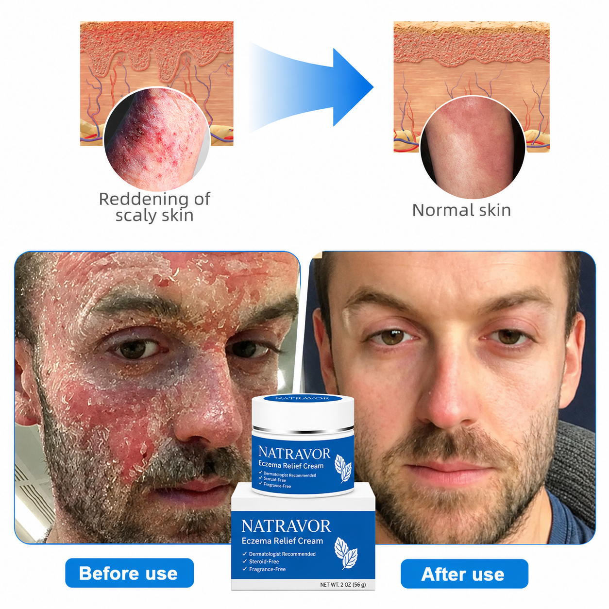 👉 Official Store: NATRAVOR®️ PCA-Magnesium Herbal Intimate – Multi‑Purpose Relief for Scalp Itching, Eczema, Jock Itch, Facial Acne & Fungal Infections | Herbal Extracts, Steroid‑Free, No Artificial Fragrances, Gentle for All Skin Types【Tax Free】