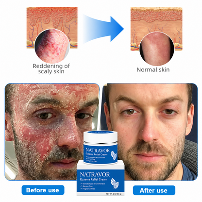 👉 Official Store: NATRAVOR®️ PCA-Magnesium Herbal Intimate – Multi‑Purpose Relief for Scalp Itching, Eczema, Jock Itch, Facial Acne & Fungal Infections | Herbal Extracts, Steroid‑Free, No Artificial Fragrances, Gentle for All Skin Types【Tax Free】