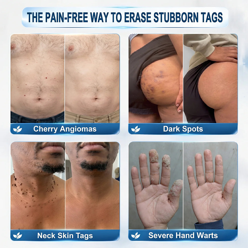 NATRAVOR® 𝟕-𝐃𝒂𝘆 𝐒𝗸𝐢𝐧 𝐓𝒂𝗴 & 𝐒𝐩𝙤𝐭 𝐄𝐫𝒂𝐬𝙚𝐫 Painless & Scar-Free Advanced Imperfection Remova𝗜 Ro𝗜𝗜erba𝗜𝗜 Pen 🌿