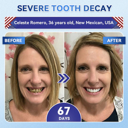 Your Smile~ 🦷 Tideglusib Fast‑Dissolving Tooth & Gum Repair Oral Strips ✨ (𝟓-𝐢𝐧-𝟏 💎 𝐑𝐞𝐛𝐮𝐢𝐥𝐝 𝐄𝐧𝐚𝐦𝐞𝐥 & 𝐃𝐞𝐧𝐭𝐢𝐧 • 𝐒𝐭𝐫𝐞𝐧𝐠𝐭𝐡𝐞𝐧 𝐆𝐮𝐦𝐬 • 𝐄𝐫𝐚𝐝𝐢𝐜𝐚𝐭𝐞 𝐓𝐚𝐫𝐭𝐚𝐫 & 𝐎𝐝𝐨𝐫 • 𝐖𝐡𝐢𝐭𝐞𝐧𝐢𝐧𝐠 • 𝐒𝐭𝐨𝐩 𝐓𝐨𝐨𝐭𝐡 𝐒𝐞𝐧𝐬𝐢𝐭𝐢𝐯𝐢𝐭𝐲)